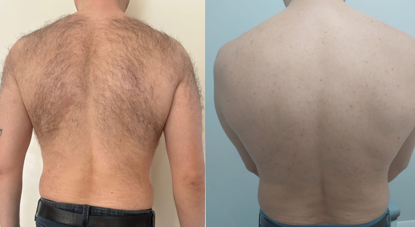 Erkek Lazer Epilasyon: Sırt Dönüşümü